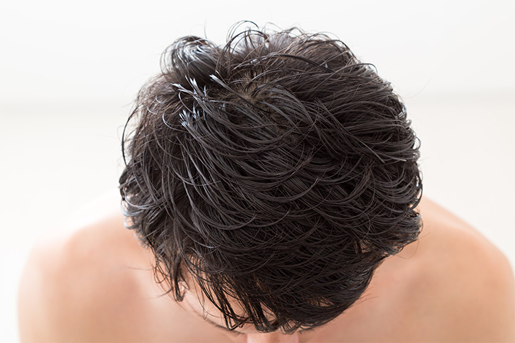 頭頂部の薄毛の原因は 自宅でできる予防と対策 薄毛治療 Agaならagaナビ アイメッド