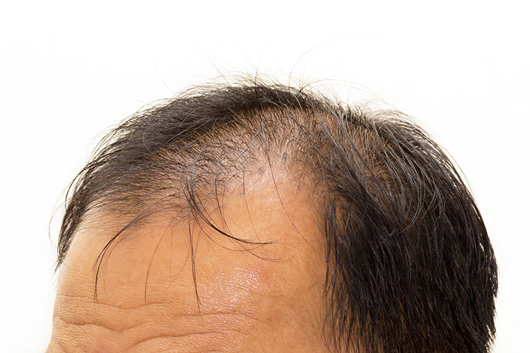 抜け毛が起こる病気はあるの 脱毛する可能性がある病気一覧 薄毛治療 Agaならagaナビ アイメッド