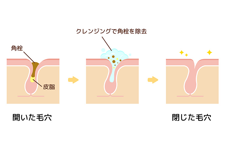 取り除く