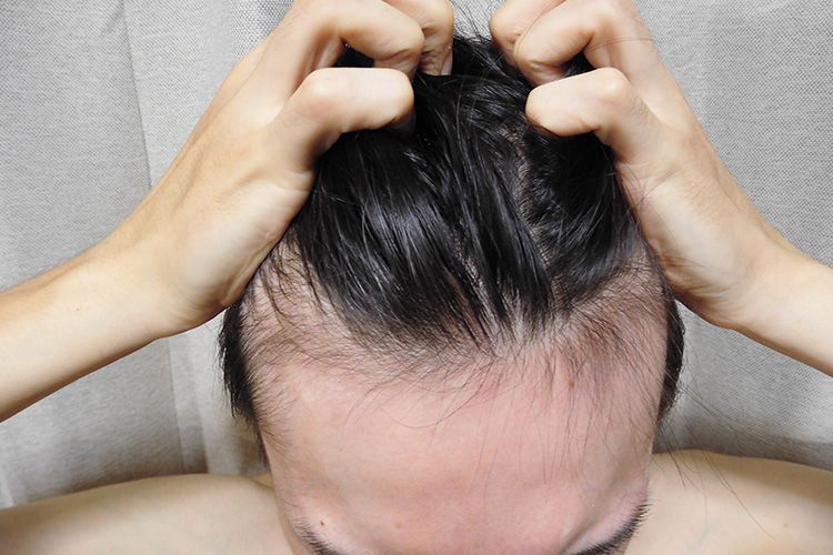 ハゲでも似合う髪型は タイプ別に髪型 スタイリングを紹介 薄毛治療 Agaならagaナビ アイメッド